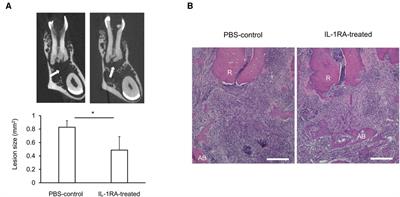 Revisiting the role of IL-1 signaling in the development of apical periodontitis